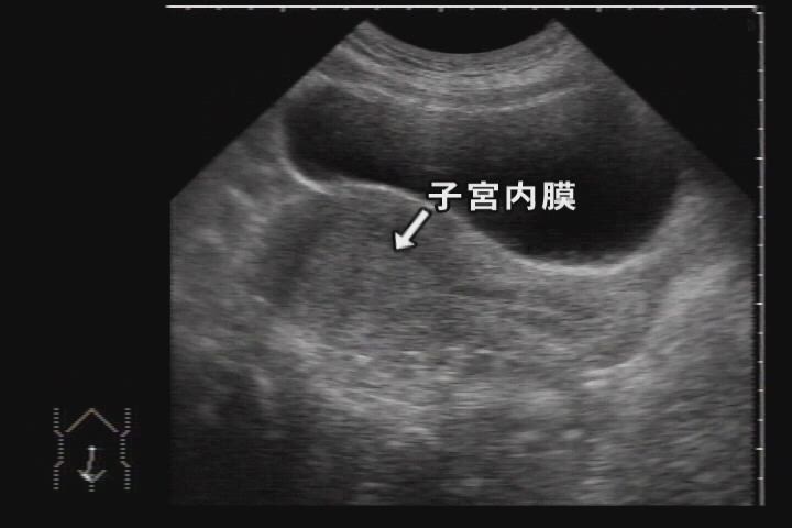 子宮腺筋症：日経メディカル