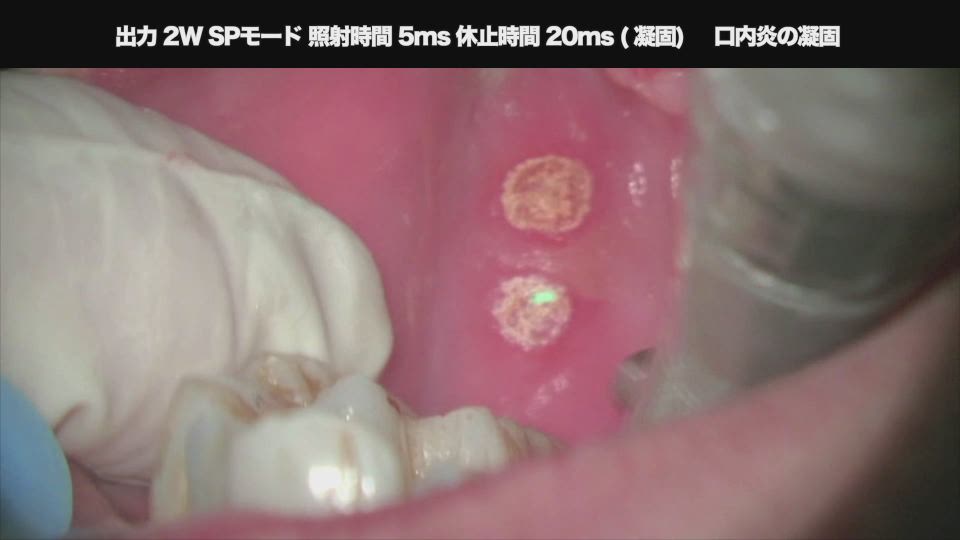 ガスレーザー 口内炎の凝固