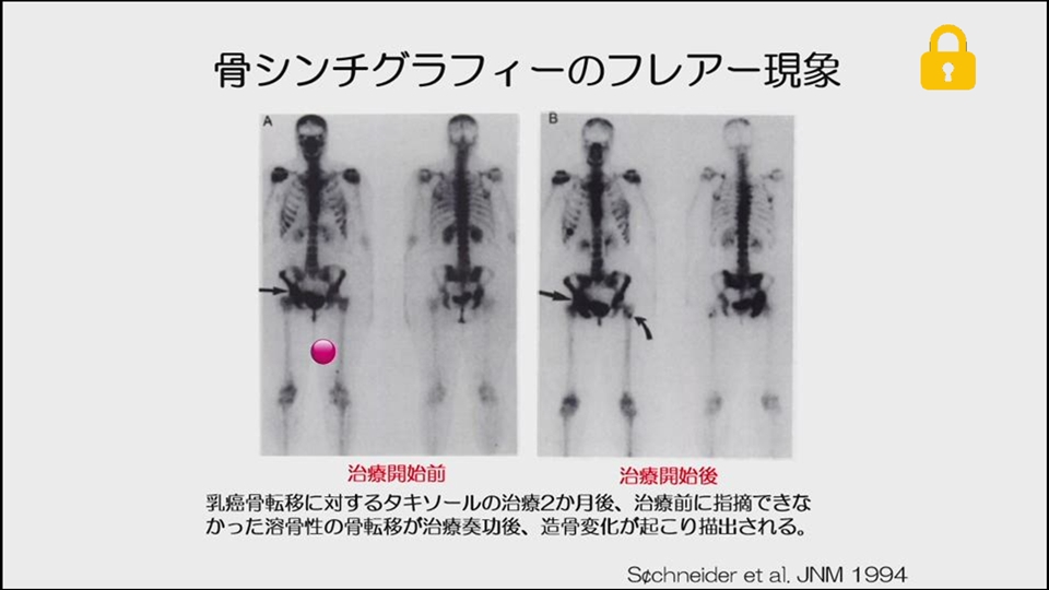 Pet Ctを乳癌骨転移診断でどう使うか 日本メジフィジックス株式会社