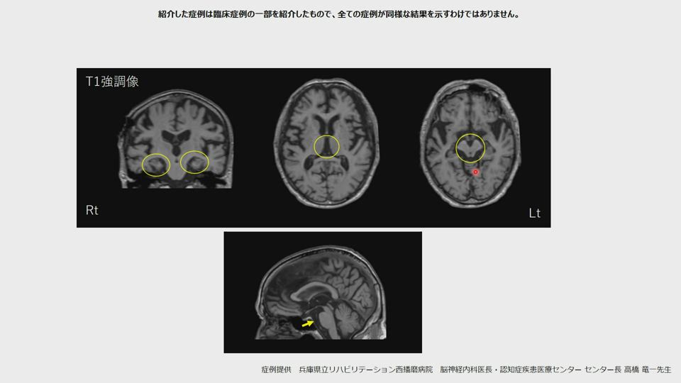 脳spect検査の活用事例強い易怒性や自発性の低下を認め 当初認知症が疑われた進行性核上性麻痺 日本メジフィジックス株式会社