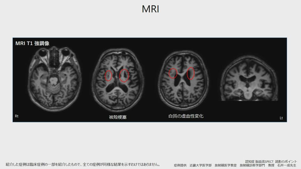 画像読影の実際 血管性認知症 Vad 日本メジフィジックス株式会社