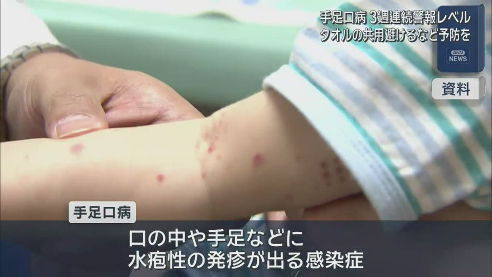 手足口病　３週連続警報レベル　15.37人に【岩手】