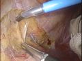 内側アプローチ（腸管膜の切開と直腸固有筋膜の露出）