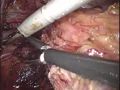 直腸間膜の処理