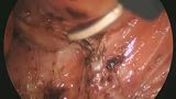 肛門挙筋上腔から尾骨直腸靭帯、肛門管までの剥離