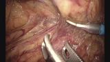 S状結腸間膜の内側授動