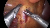 Surgical trunk郭清-1 SMV露出~回結腸動静脈の切離