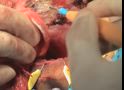 直腸の脱転と前方側の剥離～摘出