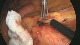 S状結腸間膜の切開からIMAの処理