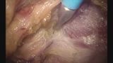 下部直腸から肛門管の剥離・授動