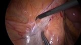 後腹膜剥離-1~卵巣動静脈の確認