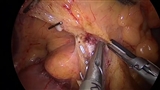 Surgical trunk郭清-2 右結腸動静脈、副右結腸静脈、中結腸動脈右枝切離