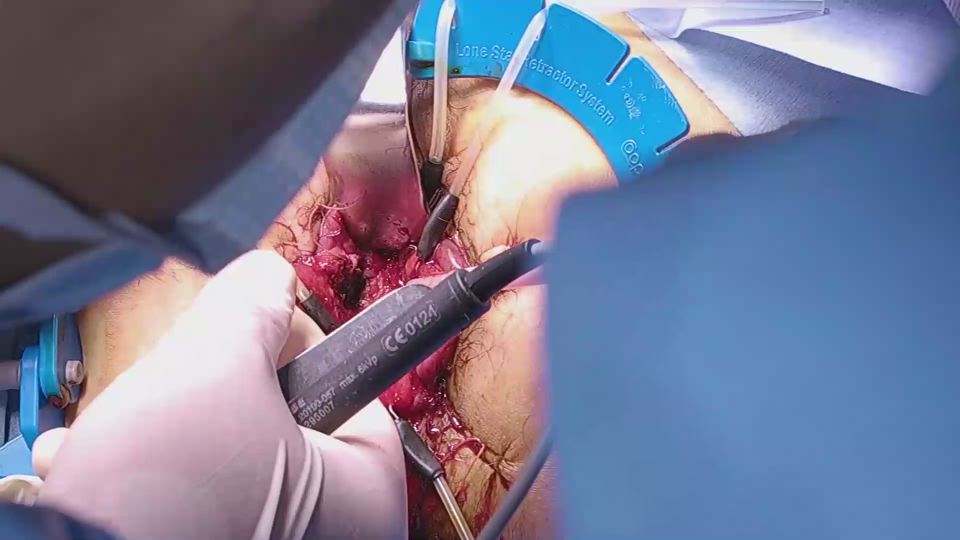 直視下での経肛門的粘膜縫合と管腔閉鎖