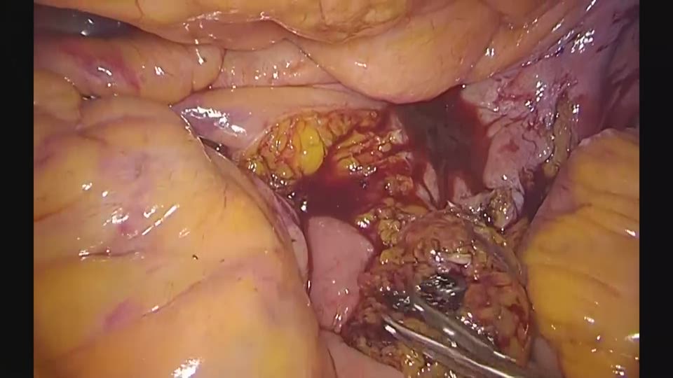 両側尿管の切離、直腸口腔の剥離