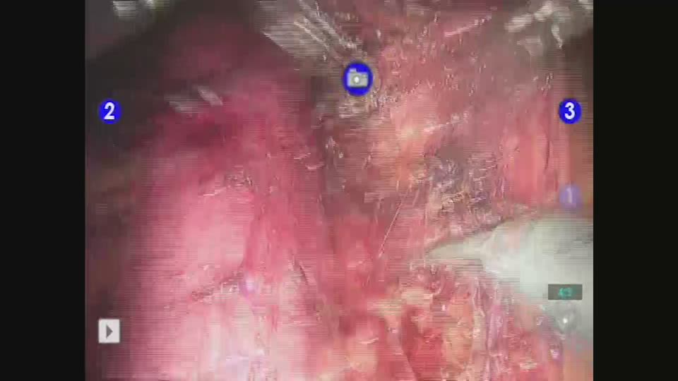 大動脈リンパ節郭清（正中～左側）
