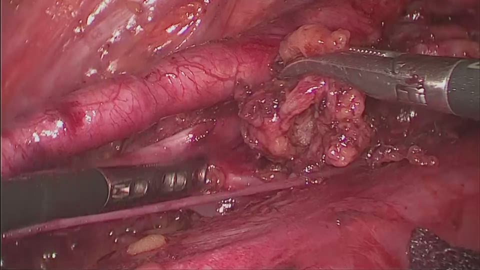左深部外側総腸骨リンパ節摘出