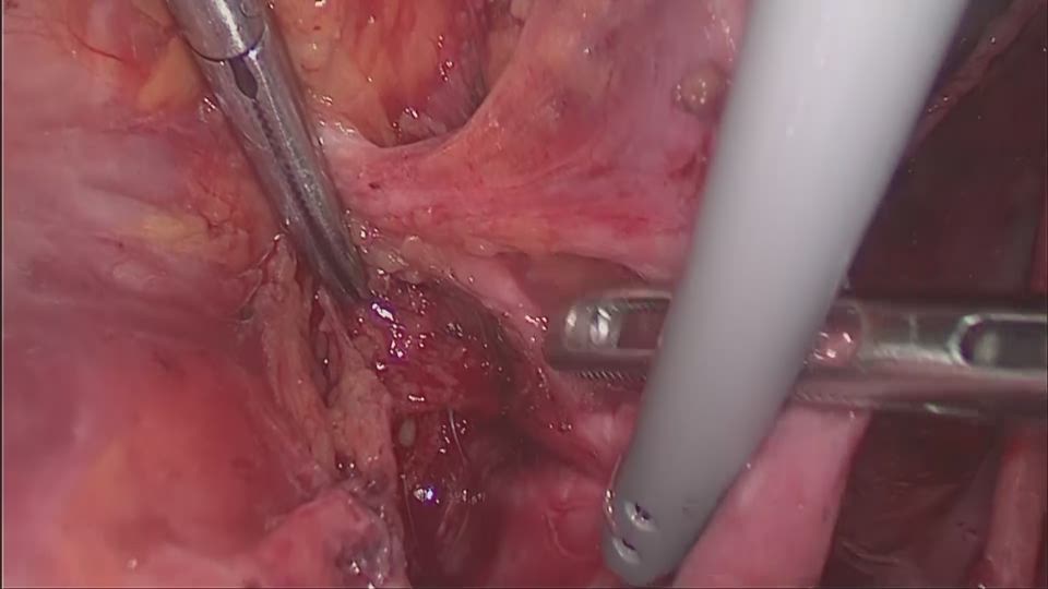 右内腸骨リンパ節摘出