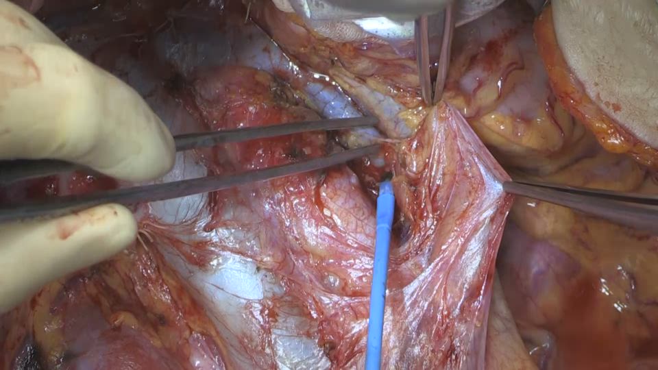 左腎静脈と左卵巣静脈の露出、下腸間膜動脈の分離