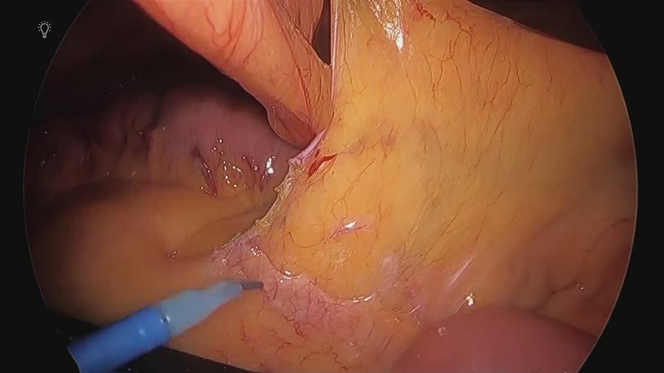 膵臓下縁から網嚢内及び外側に到達