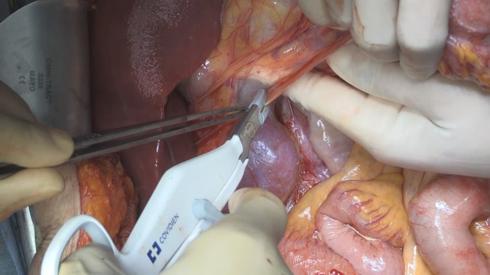 上行結腸と十二指腸の授動、郭清部分の展開