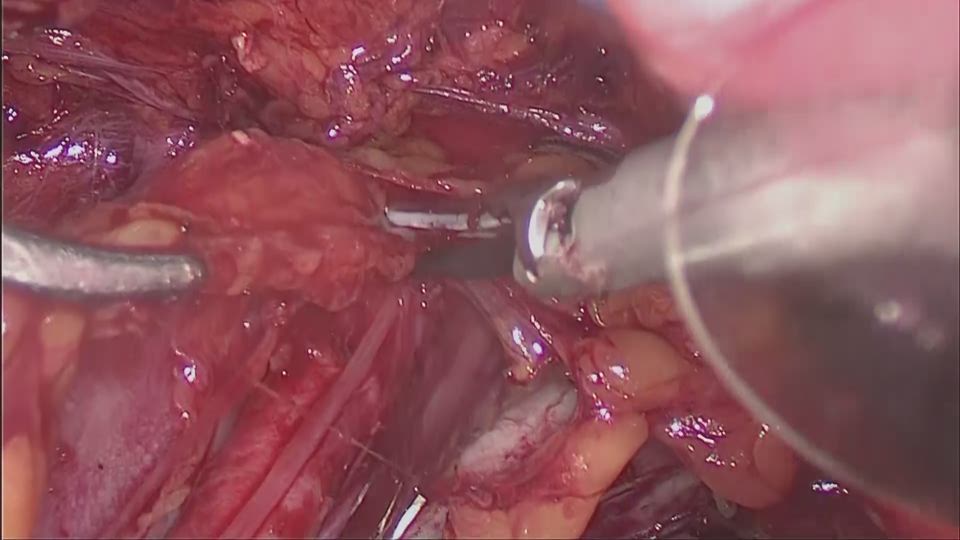 左外腸骨リンパ節摘出の補完