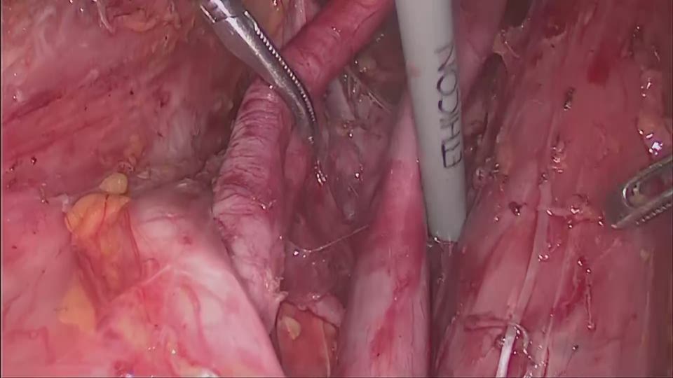 右深部外側総腸骨リンパ節摘出
