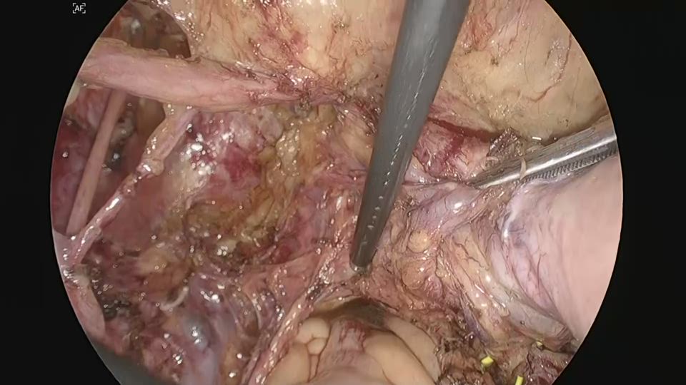 左下下腹神経叢子宮枝の切断・傍腟組織処理