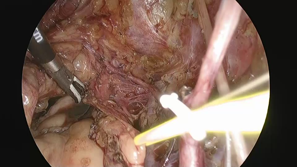 右下下腹神経叢子宮枝の切断・傍腟組織処理