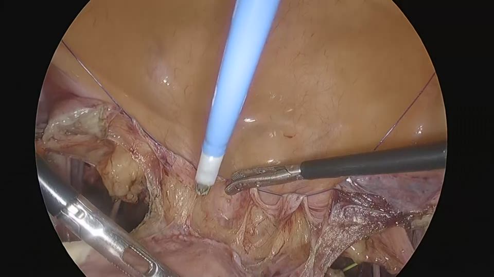膀胱腟間隙の展開