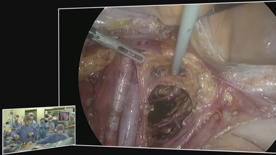 経腹膜アプローチによる大網切除および準広汎子宮全摘術および両側付属器切除術