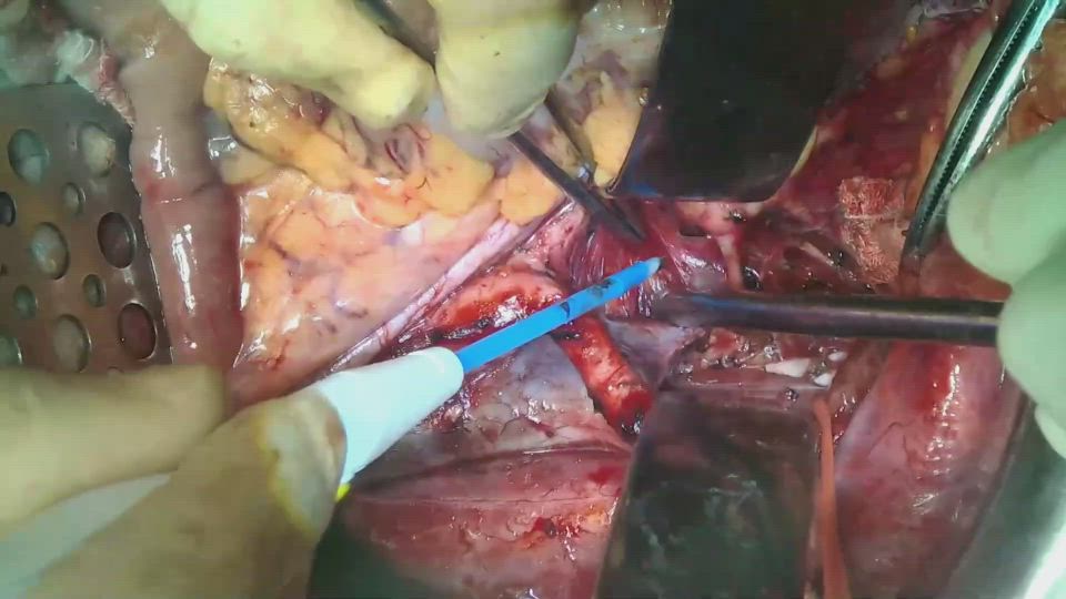 開腹骨盤リンパ節郭清（右）外腸骨血管の外側（外側総腸骨節）・血管三角部・内腸骨血管内側の郭清