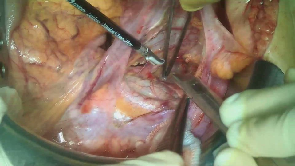 開腹骨盤リンパ節郭清（右）開始～後腹膜腔の展開