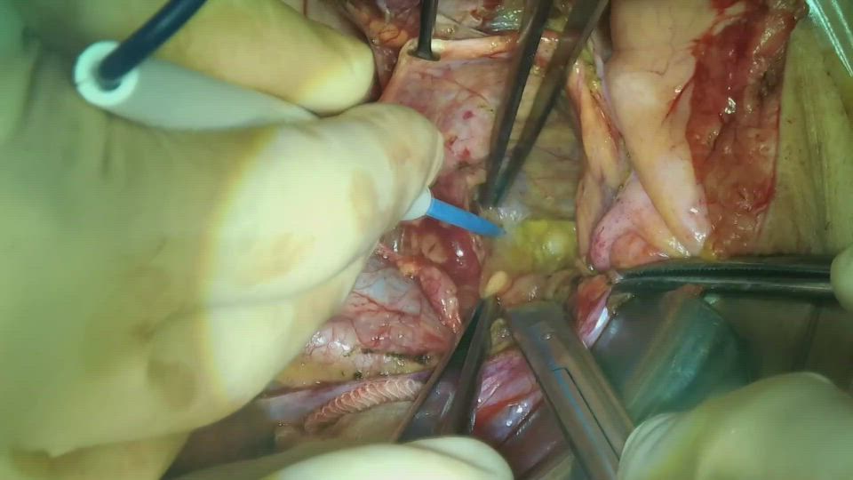 開腹骨盤リンパ節郭清（右）膀胱側腔の展開