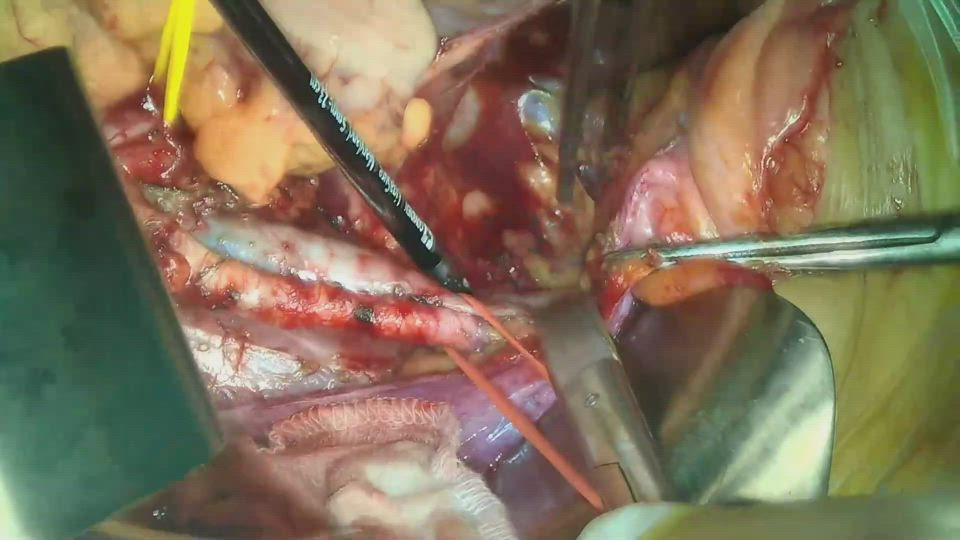 開腹骨盤リンパ節郭清（右）外腸骨領域～閉鎖腔の郭清