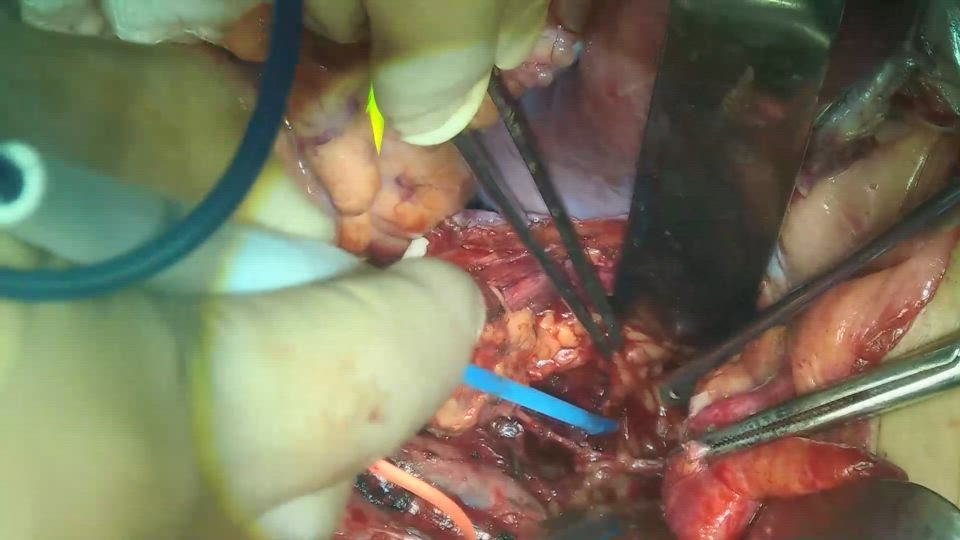 開腹骨盤リンパ節郭清（右）基靭帯起始部の郭清