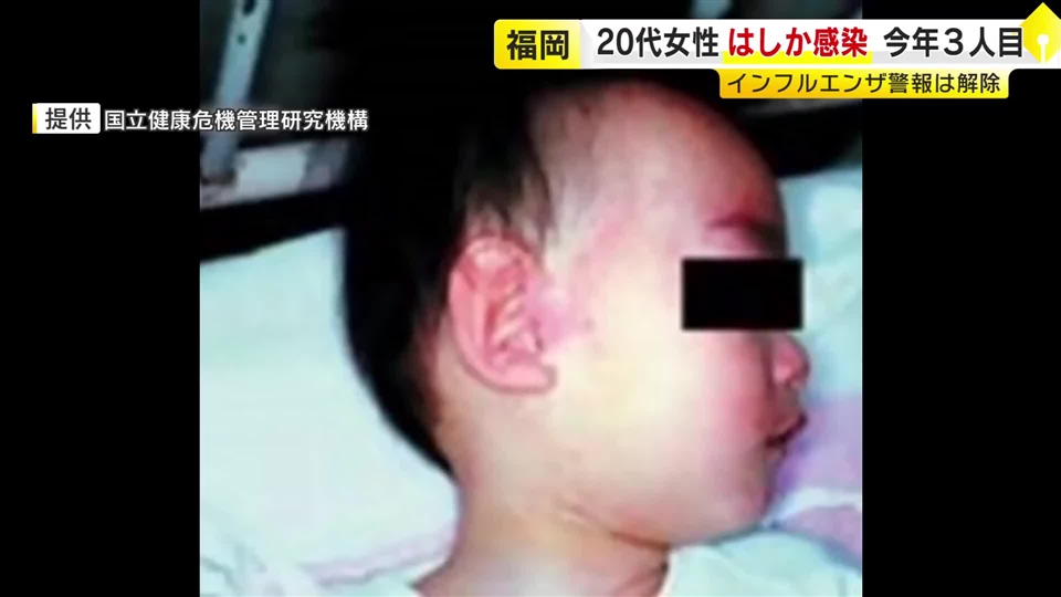 ワクチン接種歴2回あるのに感染か　福岡県内で今年3人目の「はしか」患者　海外渡航歴なしの20代女性